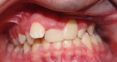 Face asymmetries in children and adolescents