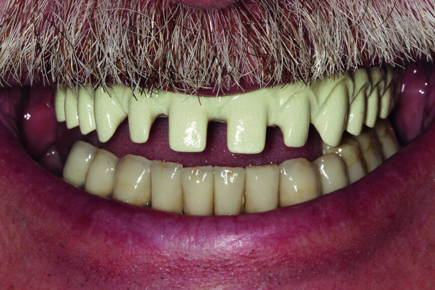 Fig. 17: Maximum smile of the patient without crowns.