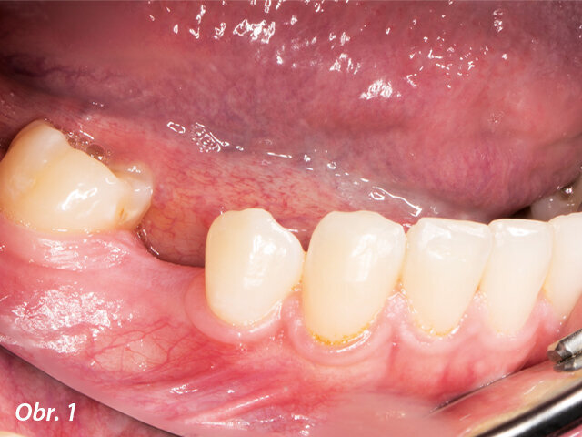 Dolní zuby pacientky před ošetřením.