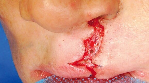 Prothetisch-ästhetische Rehabilitation bei LKG-Spalte im Erwachsenenalter