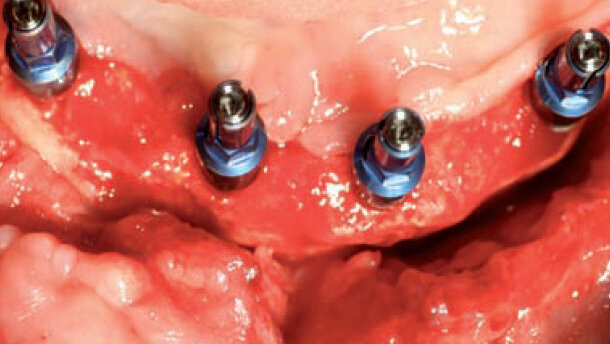 Reconstruction 3D de la crête alvéolaire chez un patient présentant une perte osseuse importante
