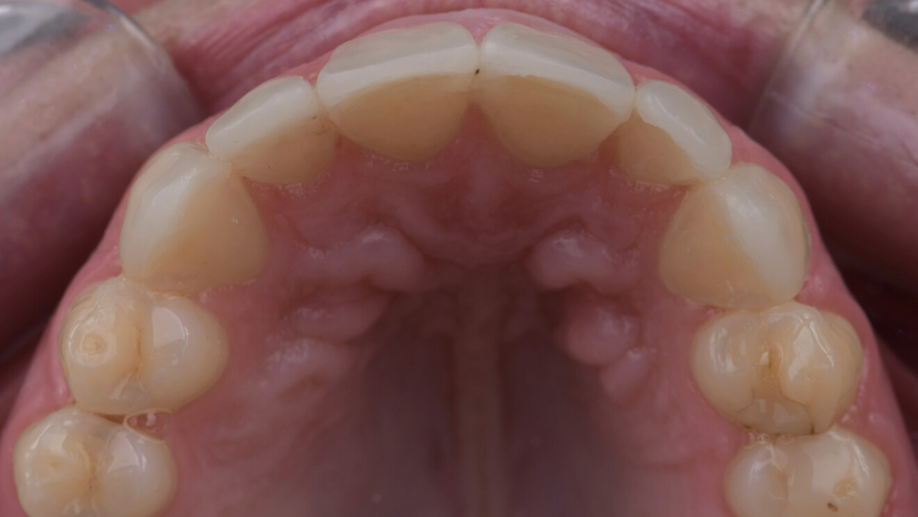 Fig. 8e: Occlusal view showing palatal adaptation of the veneers and integration within the arch.