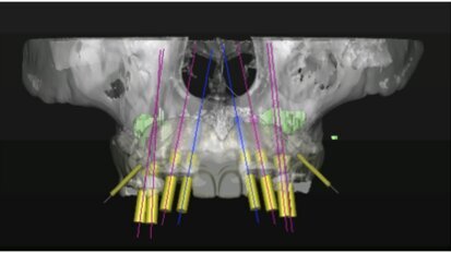 Técnicas quirúrgicas en el maxilar atrófico