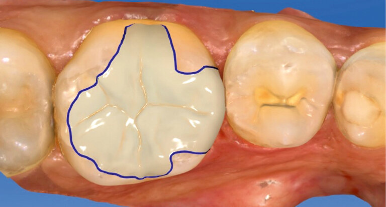 Fig. 3: Designing the inlay in the CAD module