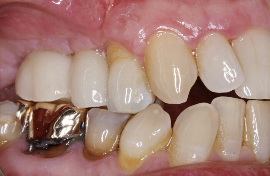 Fig. 18: Final restorations in situ.