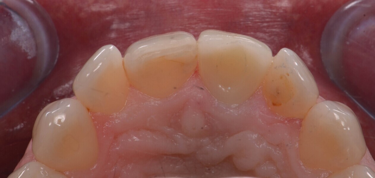 Fig. 20b : Couronne définitive implanto-portée, vue occlusale.