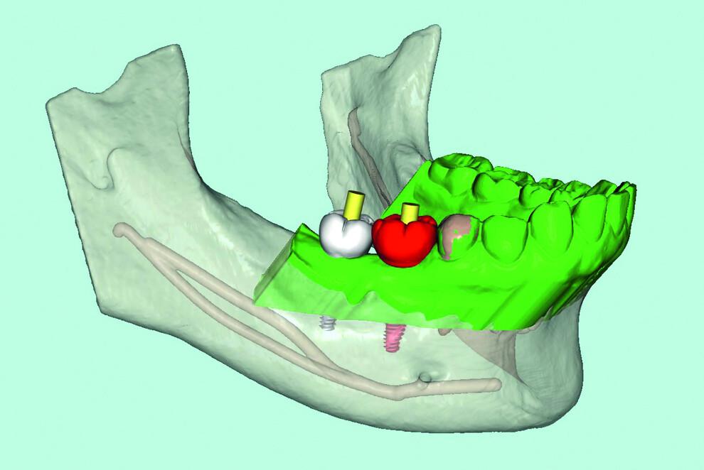 Fig. 1 : La fusion des données de scan intra-oral (en vert) avec les données CBCT, permet une planification précise et la fabrication d’un guide chirurgical.