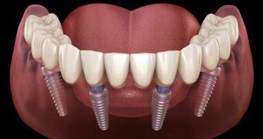 Forschungsprojekt zur Lebensdauer von Zahnimplantaten