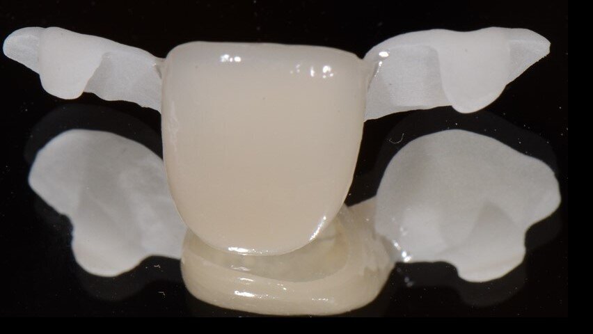 Fig. 21_Corona provvisoria fresata in PMMA.