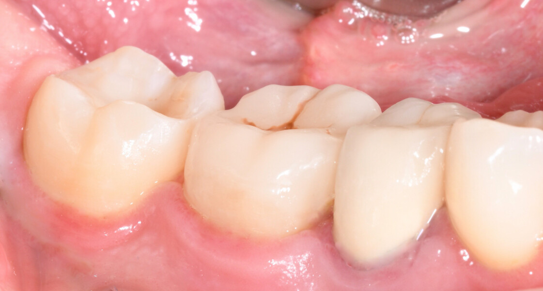 Fig. 13a: Clinical follow-up view of tooth #46 after endodontic treatment and restoration.