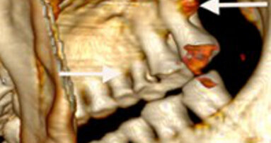 Première visite d’Ötzi chez le dentiste