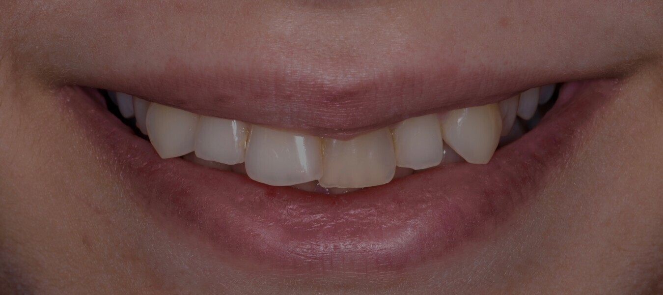 Fig. 15: Smile frontal view before treatment.