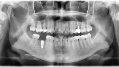 Cas clinique de chirurgie guidée : « C’est la prothèse qui guide l’implant et non le contraire. »