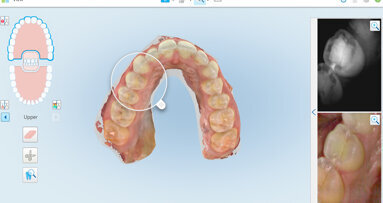 Novo kliničko ispitivanje potvrdilo novi način otkrivanja i praćenja interproksimalnog karijesa