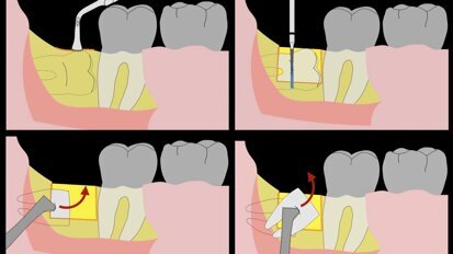 Piezocirugía  (6). Exodoncia de terceros molares simplificada
