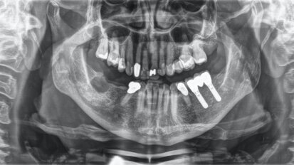 Tratamiento preventivo en paciente sana con enfermedad periodontal