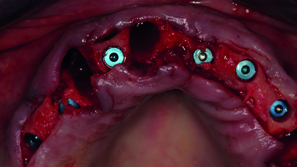 Il management della riabilitazione implanto-protesica nel paziente parzialmente edentulo