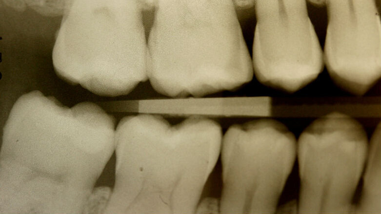 Armonia estetica funzionale e posturale con il nuovo materiale Enamel Plus Hri Bio Function