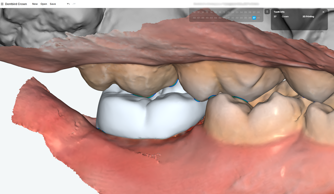 Fig. 4d: Observation of the occlusion and contour from the lingual view.