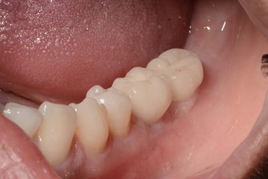 Fig. 17 : Aspect clinique de la zone des tissus mous péri-implantaires lors du suivi à un an. 