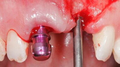 Estetyka różowa i biała – implantacja w odcinku przednim z natychmiastowym obciążeniem przy użyciu implantów MIS C1