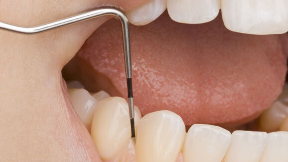 Kaum Behandlungsfehler bei Karies