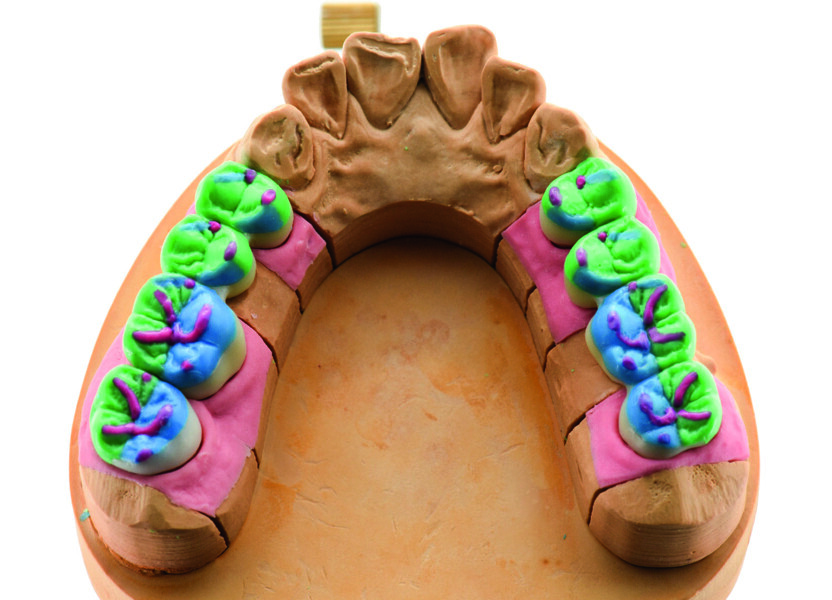 Fig. 1a : Technique de modelage en cire colorée sur la base de dents naturelles selon le prothésiste dentaire Dieter Schulz.
