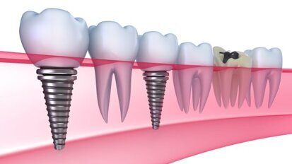 Grote verschillen in tandartsprijzen en behandeladviezen