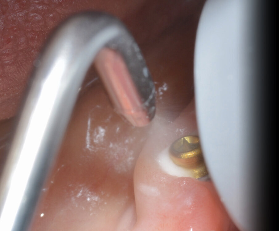 Fig. 5_Manovre di air polishing su OT Bridge.