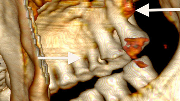 Eismumie Ötzi auf den Zahn gefühlt