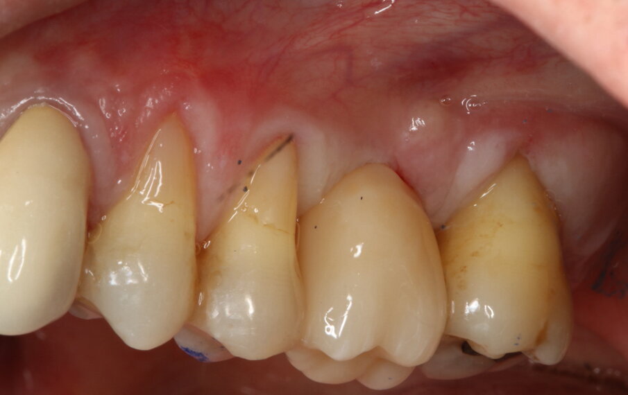 Fig. 12_Risultato clinico finale (versante vestibolare).