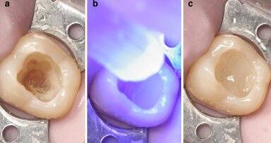Restauración clase I con composite termoviscoso