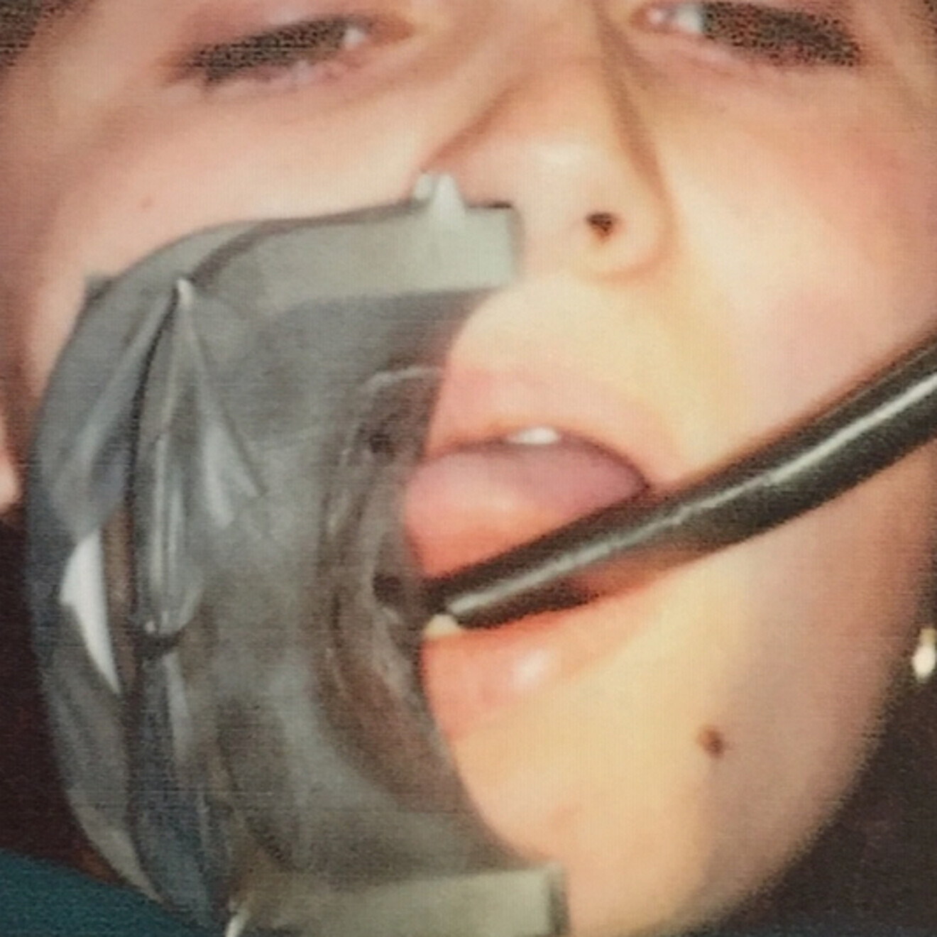 Fig. 8 : Une aspiration massive et urgente possible. 