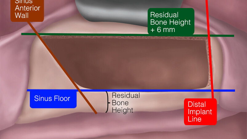 La tecnica Low Window nel grande rialzo di seno mascellare
