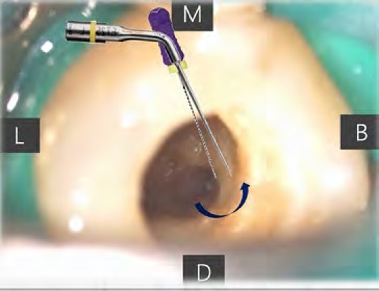Fig. 1c: The separated instrument was bypassed with a pre-curved #10 K-file to establish a negotiable pathway before retrieval. 