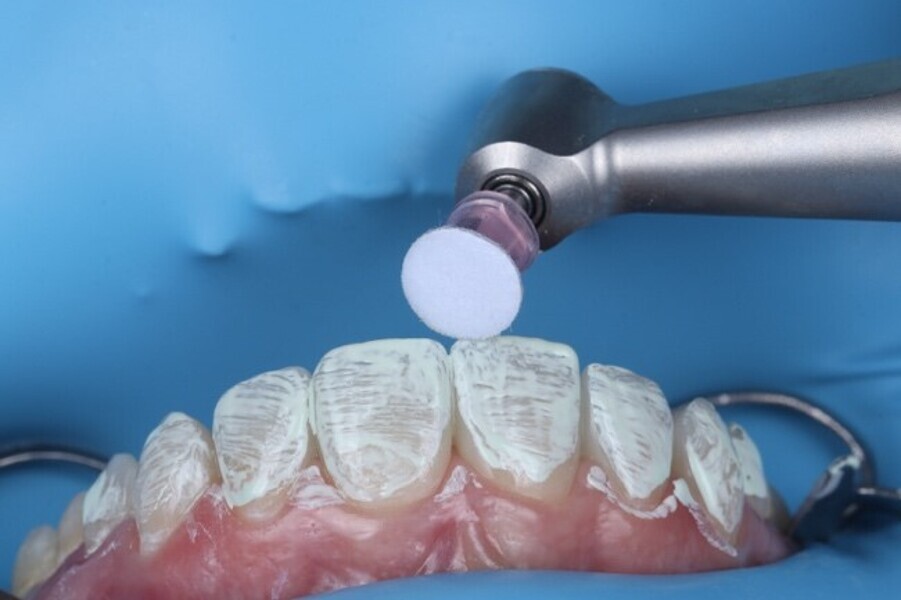 Fig. 3k: Direct dia pol ishing paste used with the super-snap buff disk for the final enamel like luster.