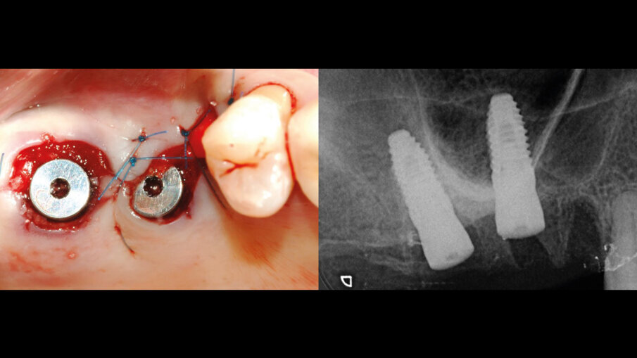 Fig. 8 - Chiusura dei lembi e guarigione per seconda intenzione. L’RX conferma il corretto posizionamento implantare.