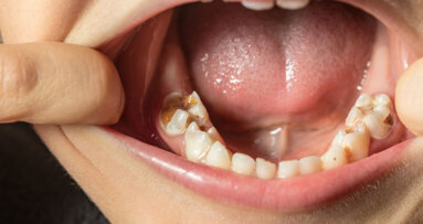 Effektive Kariesprävention in Schulen mit Silberdiaminfluorid