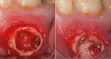 New perspectives in periapical surgery: Hemostasis