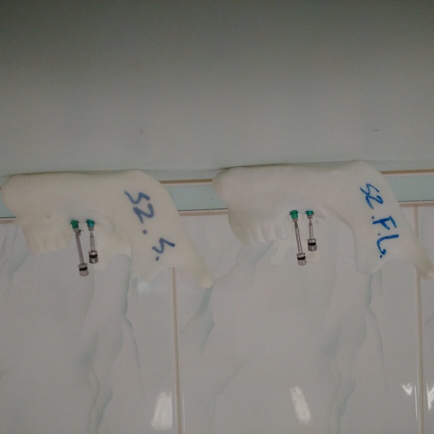 Ryc. 6_Modele po procedurach z użyciem szablonu. Widoczne są te same osie wprowadzonych implantów.