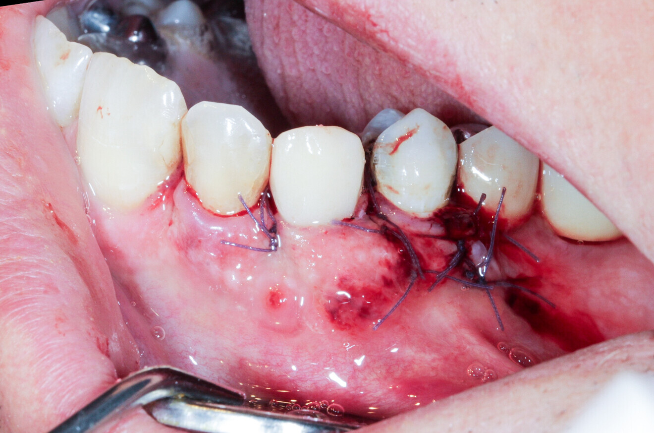 Fig. 18: A #5/0 resorbable braided thread was used for the sutures.