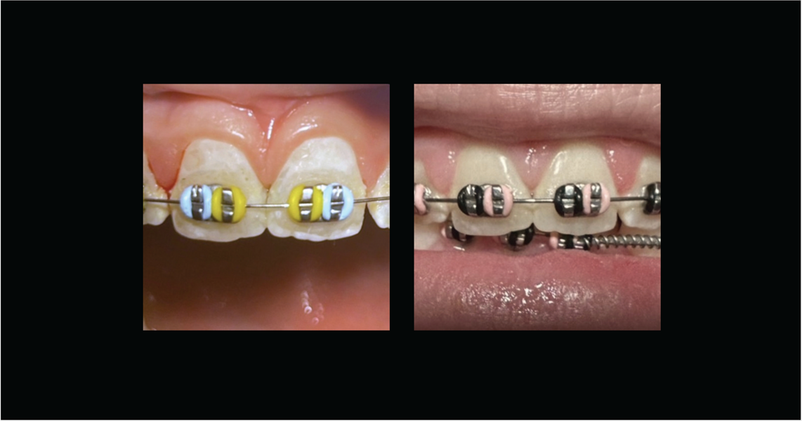 Treatment with Curodont Repair Fluoride Plus: Before (left) and after five months. (Images: Misty Mattingly)