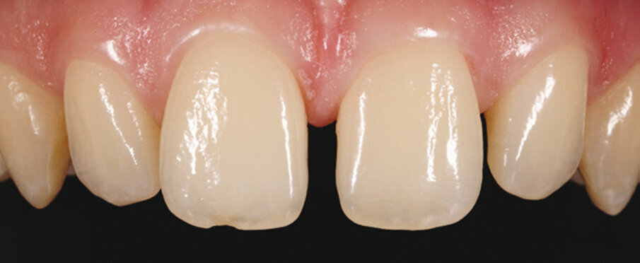 2. Početni nalaz sa zdravom gingivom i medijalnom dijastemom. 