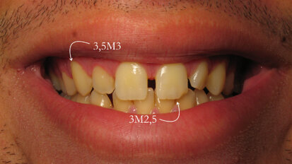 50 nuances de blanc, l’éclaircissement dentaire jour après jour
