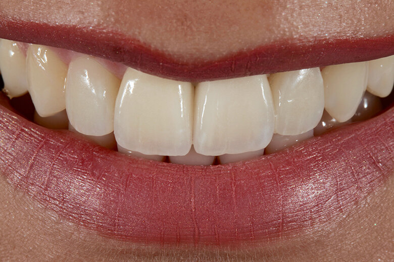 Fig. 13. Los bordes incisales simétricos armonizan con el contorno de los labios.