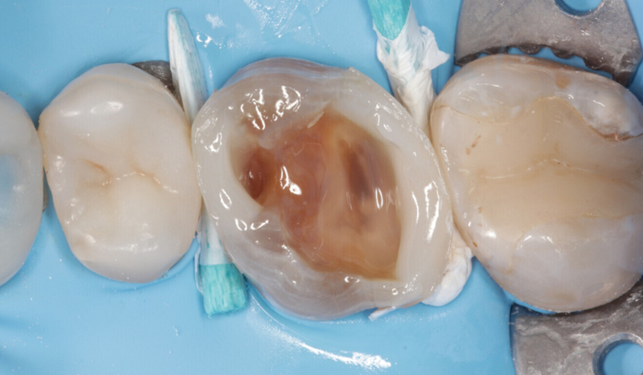 Fig. 12: Thin layer of CLEARFIL MAJESTY ES Flow High (Shade A2) applied on the cavity floor. The proximal walls were built up with CLEARFIL MAJESTY ES-2 Universal and CLEARFIL MAJESTY ES Flow Super Low (Shade A2). (Image: Kuraray Noritake Dental)