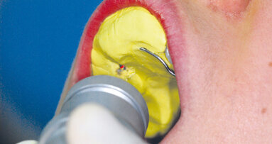 Svařování v ordinaci pomocí Nd:YAG laseru