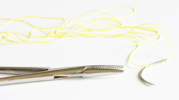 Neue Methode zum Wundverschluss