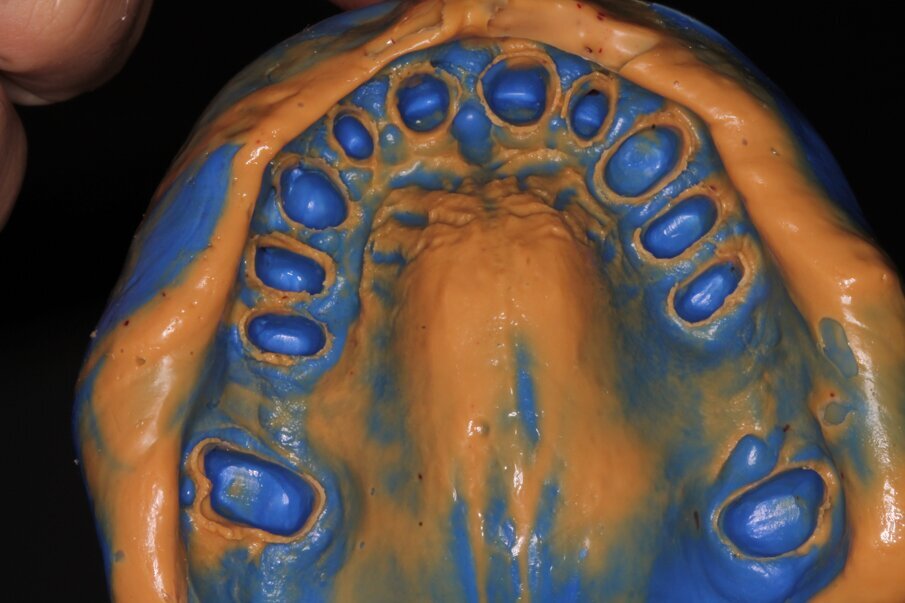 Fig. 15: Upper jaw impression for the fabrication of the permanent restorations