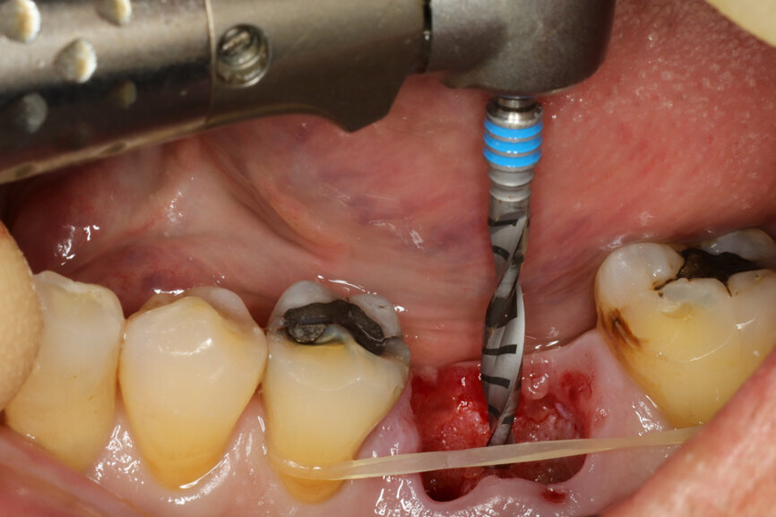 Fig. 6: Osteotomy with the ⌀ 2.2 mm drill.